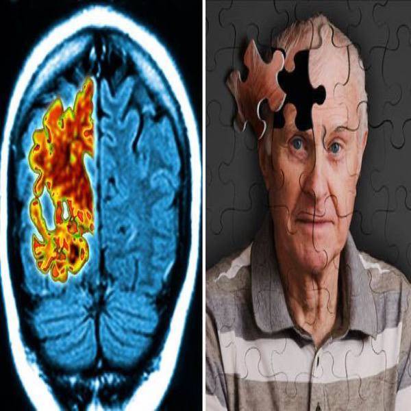 علائم بیماری آلزایمر