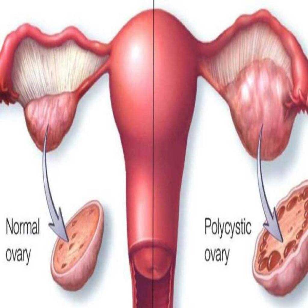 سندروم تخمدان پلی کیستیک ( Polycystic ovary syndrome (PCOS